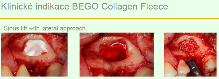 Bego Collagen Fleece