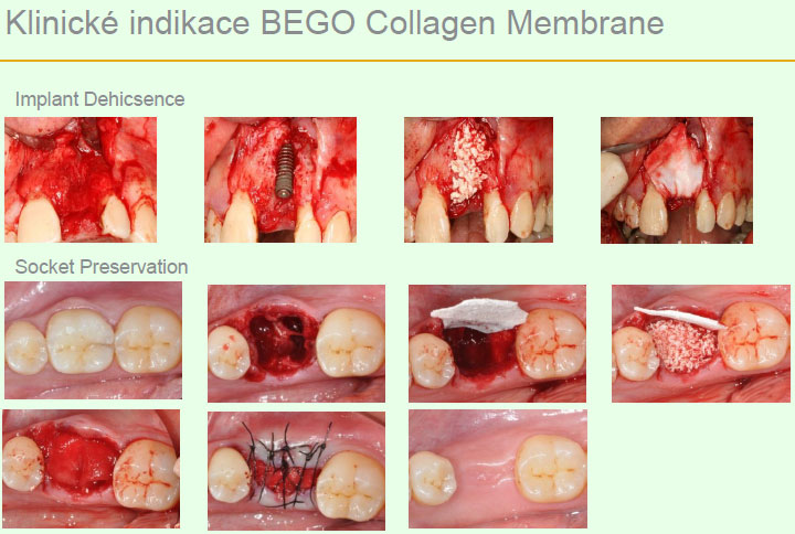 Bego Collagen Membrane